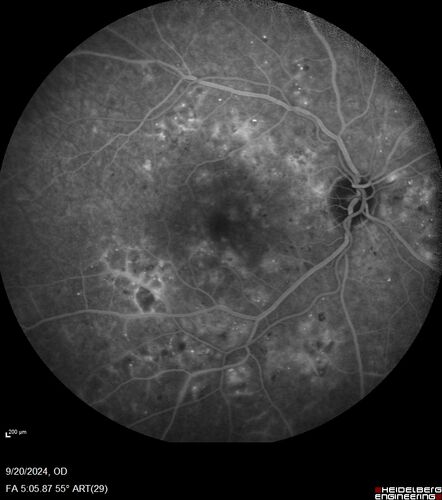Severe NPDR
53 year old man with blurred vision (needs glasses).
Diabetic for 10 years with poor control
VA 20/32 OU
