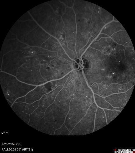 Severe NPDR
53 year old man with blurred vision (needs glasses).
Diabetic for 10 years with poor control
VA 20/32 OU
