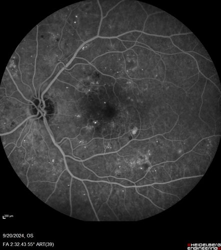 Severe NPDR
53 year old man with blurred vision (needs glasses).
Diabetic for 10 years with poor control
VA 20/32 OU

