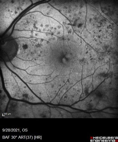 Nonproliferative Diabetic Retinopathy and Good Vision
59 year old man Vision is good.  Just referred following annual eye examination
PMHx: Type II DM, HTN, Cholesterol, 
MEDS: Lantus, Metformin, lisinopril, atorvastatin, gabapentin

VA 20/20 OU
2+ NS OU

Observation
