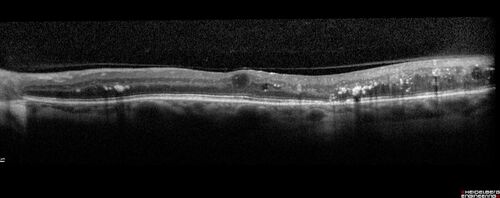 Nonproliferative Diabetic Retinopathy and Good Vision
59 year old man Vision is good.  Just referred following annual eye examination
PMHx: Type II DM, HTN, Cholesterol, 
MEDS: Lantus, Metformin, lisinopril, atorvastatin, gabapentin

VA 20/20 OU
2+ NS OU

Observation

