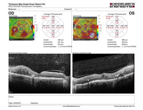 Nonproliferative Diabetic Retinopathy and Good Vision
59 year old man Vision is good.  Just referred following annual eye examination
PMHx: Type II DM, HTN, Cholesterol, 
MEDS: Lantus, Metformin, lisinopril, atorvastatin, gabapentin

VA 20/20 OU
2+ NS OU

Observation

