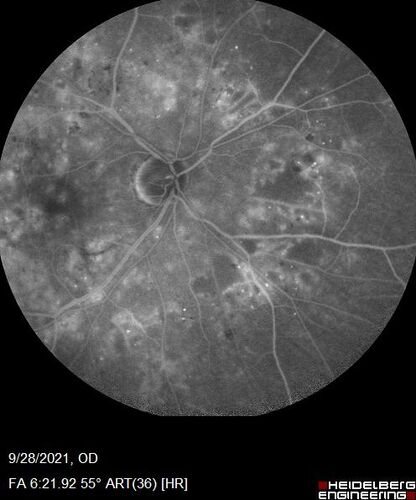 Nonproliferative Diabetic Retinopathy and Good Vision
59 year old man Vision is good.  Just referred following annual eye examination
PMHx: Type II DM, HTN, Cholesterol, 
MEDS: Lantus, Metformin, lisinopril, atorvastatin, gabapentin

VA 20/20 OU
2+ NS OU

Observation
