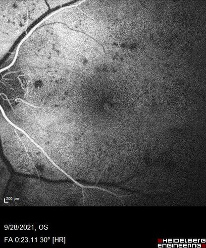 Nonproliferative Diabetic Retinopathy and Good Vision
59 year old man Vision is good.  Just referred following annual eye examination
PMHx: Type II DM, HTN, Cholesterol, 
MEDS: Lantus, Metformin, lisinopril, atorvastatin, gabapentin

VA 20/20 OU
2+ NS OU

Observation
