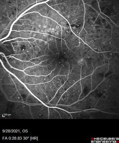 Nonproliferative Diabetic Retinopathy and Good Vision
59 year old man Vision is good.  Just referred following annual eye examination
PMHx: Type II DM, HTN, Cholesterol, 
MEDS: Lantus, Metformin, lisinopril, atorvastatin, gabapentin

VA 20/20 OU
2+ NS OU

Observation
