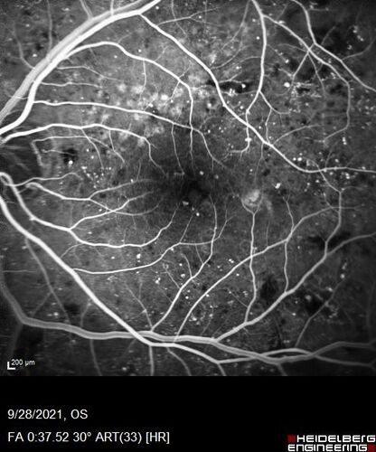 Nonproliferative Diabetic Retinopathy and Good Vision
59 year old man Vision is good.  Just referred following annual eye examination
PMHx: Type II DM, HTN, Cholesterol, 
MEDS: Lantus, Metformin, lisinopril, atorvastatin, gabapentin

VA 20/20 OU
2+ NS OU

Observation
