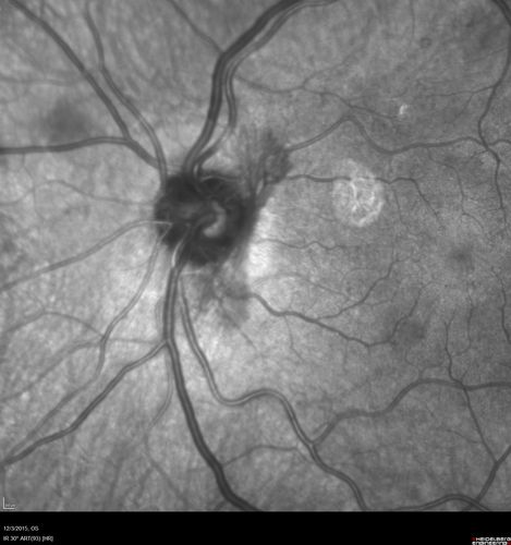 Proliferative Diabetic Retinopathy - NVD regressed with PRP laser
76 year old diabetic man - Presented one year ago with NVD in the left eye.  This regressed with laser but then a year later worsened.  Additional PRP was done and the NVD regressed again.

