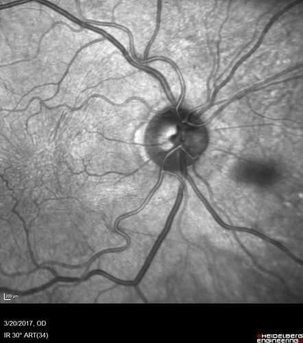 Proliferative Diabetic Retinopathy - NVD regressed with PRP laser
76 year old diabetic man - Presented one year ago with NVD in the left eye.  This regressed with laser but then a year later worsened.  Additional PRP was done and the NVD regressed again.
