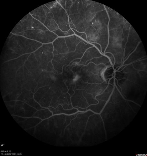 Proliferative Diabetic Retinopathy - NVD regressed with PRP laser
76 year old diabetic man - Presented one year ago with NVD in the left eye.  This regressed with laser but then a year later worsened.  Additional PRP was done and the NVD regressed again.
