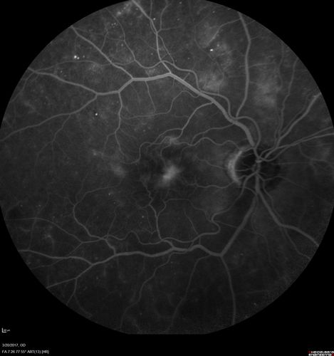Proliferative Diabetic Retinopathy - NVD regressed with PRP laser
76 year old diabetic man - Presented one year ago with NVD in the left eye.  This regressed with laser but then a year later worsened.  Additional PRP was done and the NVD regressed again.
