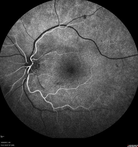 Proliferative Diabetic Retinopathy - NVD regressed with PRP laser
76 year old diabetic man - Presented one year ago with NVD in the left eye.  This regressed with laser but then a year later worsened.  Additional PRP was done and the NVD regressed again.
