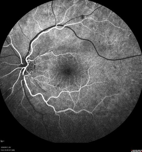 Proliferative Diabetic Retinopathy - NVD regressed with PRP laser
76 year old diabetic man - Presented one year ago with NVD in the left eye.  This regressed with laser but then a year later worsened.  Additional PRP was done and the NVD regressed again.
