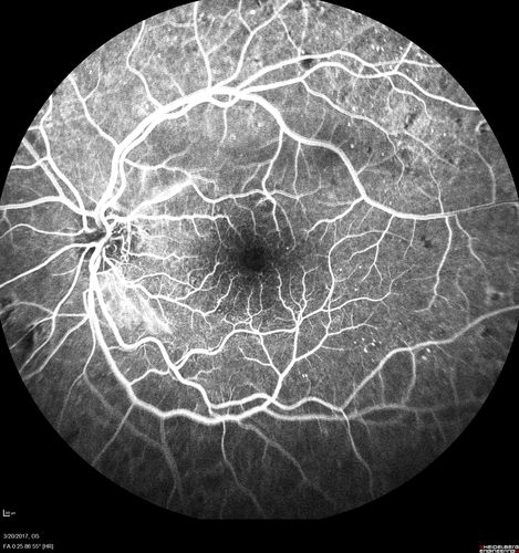 Proliferative Diabetic Retinopathy - NVD regressed with PRP laser
76 year old diabetic man - Presented one year ago with NVD in the left eye.  This regressed with laser but then a year later worsened.  Additional PRP was done and the NVD regressed again.
