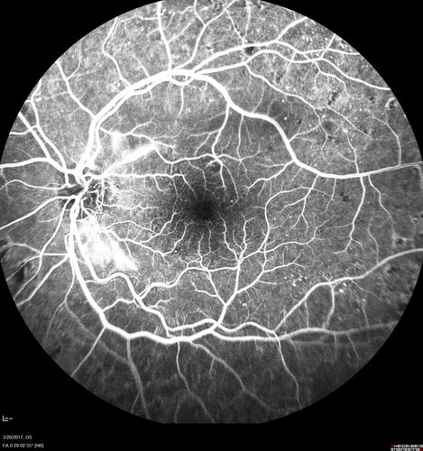 Proliferative Diabetic Retinopathy - NVD regressed with PRP laser
76 year old diabetic man - Presented one year ago with NVD in the left eye.  This regressed with laser but then a year later worsened.  Additional PRP was done and the NVD regressed again.
