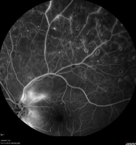 Proliferative Diabetic Retinopathy - NVD regressed with PRP laser
76 year old diabetic man - Presented one year ago with NVD in the left eye.  This regressed with laser but then a year later worsened.  Additional PRP was done and the NVD regressed again.
