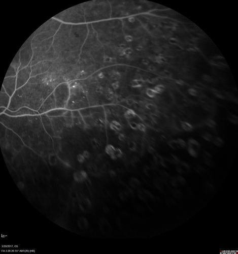 Proliferative Diabetic Retinopathy - NVD regressed with PRP laser
76 year old diabetic man - Presented one year ago with NVD in the left eye.  This regressed with laser but then a year later worsened.  Additional PRP was done and the NVD regressed again.
