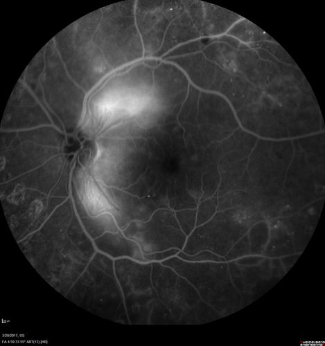 Proliferative Diabetic Retinopathy - NVD regressed with PRP laser
76 year old diabetic man - Presented one year ago with NVD in the left eye.  This regressed with laser but then a year later worsened.  Additional PRP was done and the NVD regressed again.
