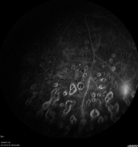 Proliferative Diabetic Retinopathy - NVD regressed with PRP laser
76 year old diabetic man - Presented one year ago with NVD in the left eye.  This regressed with laser but then a year later worsened.  Additional PRP was done and the NVD regressed again.
