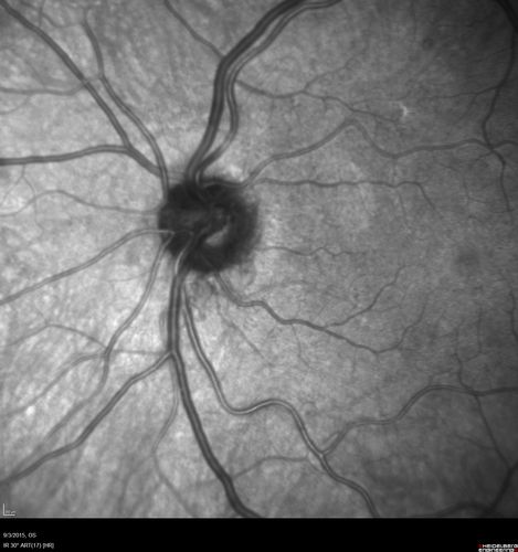 Proliferative Diabetic Retinopathy - NVD regressed with PRP laser - Regression following Initial PRP laser
76 year old diabetic man - Presented one year ago with NVD in the left eye.  This regressed with laser but then a year later worsened.  Additional PRP was done and the NVD regressed again.
