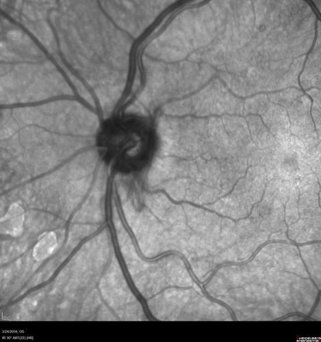 Proliferative Diabetic Retinopathy - NVD regressed with PRP laser - Prior to initial laser
76 year old diabetic man - Presented one year ago with NVD in the left eye.  This regressed with laser but then a year later worsened.  Additional PRP was done and the NVD regressed again.
