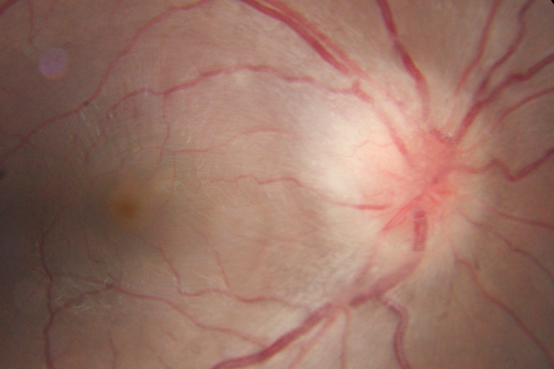 Neuroretinitis Positive IgM Bartonella henselae
33 year old with vision loss.  Her vision improved and she was treated with ciprofloxacen
