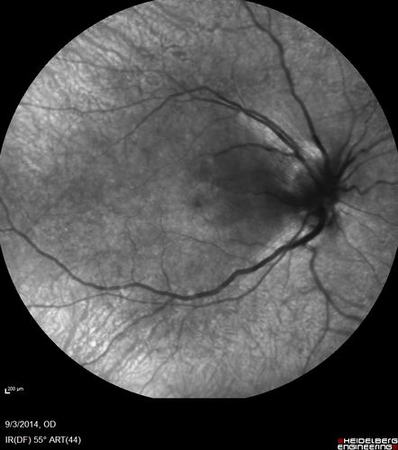 Neuroretinitis Positive IgM Bartonella henselae
33 year old with vision loss.  Her vision improved and she was treated with ciprofloxacen
