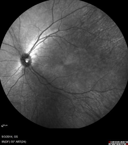 Neuroretinitis Positive IgM Bartonella henselae
33 year old with vision loss.  Her vision improved and she was treated with ciprofloxacen
