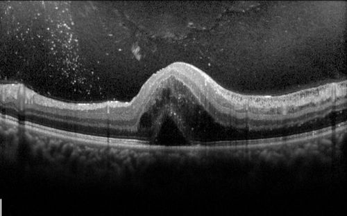 Neuroretinitis Positive IgM Bartonella henselae
33 year old with vision loss.  Her vision improved and she was treated with ciprofloxacen
