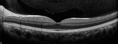 Neuroretinitis Positive IgM Bartonella henselae
33 year old with vision loss.  Her vision improved and she was treated with ciprofloxacen
