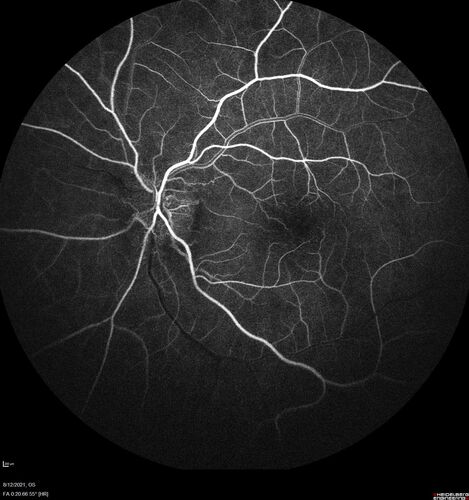 Neuroretinitis left eye - recovered with no therapy - possible B pertussis
57 year old female The patient has had blurred vision in the left eye and there is a haze across the top of the vision.Â  This started about 2 weeks ago.Â  The right eye is OK.Â  She has sleep apnea and uses the machine.Â  The left eye is becoming more and more painful for the last two weeks.Â  The pain is like a stabbing in the eye that comes and goes.Â  She also has some pain on eye movement.Â  The patient has been going to Moffit for possible reconstructive surgery for the lymphedema.
PMHx â€“ Sleep apnea, Breast Cancer, Adult lymphedema, 
Meds: GabapentinÂ 
VA OD: Dcc20/25-1
VA OS: Dcc20/100-2
AC quiet OU.  1 + NS cataract OU
IOP: TP: OD:15 OS:17
