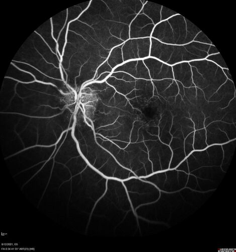 Neuroretinitis left eye - recovered with no therapy - possible B pertussis
57 year old female The patient has had blurred vision in the left eye and there is a haze across the top of the vision.Â  This started about 2 weeks ago.Â  The right eye is OK.Â  She has sleep apnea and uses the machine.Â  The left eye is becoming more and more painful for the last two weeks.Â  The pain is like a stabbing in the eye that comes and goes.Â  She also has some pain on eye movement.Â  The patient has been going to Moffit for possible reconstructive surgery for the lymphedema.
PMHx â€“ Sleep apnea, Breast Cancer, Adult lymphedema, 
Meds: GabapentinÂ 
VA OD: Dcc20/25-1
VA OS: Dcc20/100-2
AC quiet OU.  1 + NS cataract OU
IOP: TP: OD:15 OS:17
