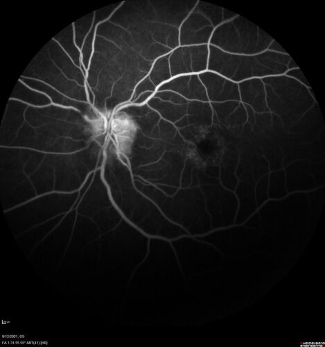 Neuroretinitis left eye - recovered with no therapy - possible B pertussis
57 year old female The patient has had blurred vision in the left eye and there is a haze across the top of the vision.Â  This started about 2 weeks ago.Â  The right eye is OK.Â  She has sleep apnea and uses the machine.Â  The left eye is becoming more and more painful for the last two weeks.Â  The pain is like a stabbing in the eye that comes and goes.Â  She also has some pain on eye movement.Â  The patient has been going to Moffit for possible reconstructive surgery for the lymphedema.
PMHx â€“ Sleep apnea, Breast Cancer, Adult lymphedema, 
Meds: GabapentinÂ 
VA OD: Dcc20/25-1
VA OS: Dcc20/100-2
AC quiet OU.  1 + NS cataract OU
IOP: TP: OD:15 OS:17
