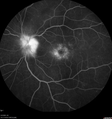 Neuroretinitis left eye - recovered with no therapy - possible B pertussis
57 year old female The patient has had blurred vision in the left eye and there is a haze across the top of the vision.Â  This started about 2 weeks ago.Â  The right eye is OK.Â  She has sleep apnea and uses the machine.Â  The left eye is becoming more and more painful for the last two weeks.Â  The pain is like a stabbing in the eye that comes and goes.Â  She also has some pain on eye movement.Â  The patient has been going to Moffit for possible reconstructive surgery for the lymphedema.
PMHx â€“ Sleep apnea, Breast Cancer, Adult lymphedema, 
Meds: GabapentinÂ 
VA OD: Dcc20/25-1
VA OS: Dcc20/100-2
AC quiet OU.  1 + NS cataract OU
IOP: TP: OD:15 OS:17

