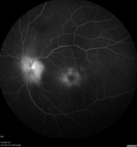 Neuroretinitis left eye - recovered with no therapy - possible B pertussis
57 year old female The patient has had blurred vision in the left eye and there is a haze across the top of the vision.Â  This started about 2 weeks ago.Â  The right eye is OK.Â  She has sleep apnea and uses the machine.Â  The left eye is becoming more and more painful for the last two weeks.Â  The pain is like a stabbing in the eye that comes and goes.Â  She also has some pain on eye movement.Â  The patient has been going to Moffit for possible reconstructive surgery for the lymphedema.
PMHx â€“ Sleep apnea, Breast Cancer, Adult lymphedema, 
Meds: GabapentinÂ 
VA OD: Dcc20/25-1
VA OS: Dcc20/100-2
AC quiet OU.  1 + NS cataract OU
IOP: TP: OD:15 OS:17
