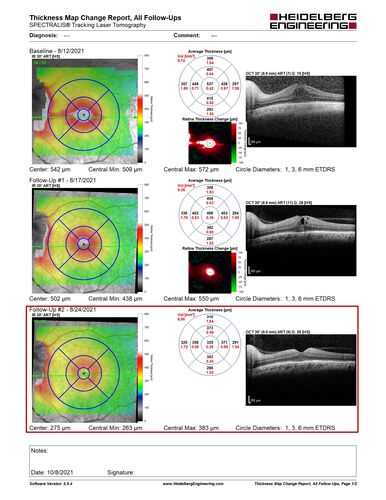Neuroretinitis left eye - recovered with no therapy - possible B pertussis
57 year old female The patient has had blurred vision in the left eye and there is a haze across the top of the vision.Â  This started about 2 weeks ago.Â  The right eye is OK.Â  She has sleep apnea and uses the machine.Â  The left eye is becoming more and more painful for the last two weeks.Â  The pain is like a stabbing in the eye that comes and goes.Â  She also has some pain on eye movement.Â  The patient has been going to Moffit for possible reconstructive surgery for the lymphedema.
PMHx â€“ Sleep apnea, Breast Cancer, Adult lymphedema, 
Meds: GabapentinÂ 
VA OD: Dcc20/25-1
VA OS: Dcc20/100-2
AC quiet OU.  1 + NS cataract OU
IOP: TP: OD:15 OS:17
