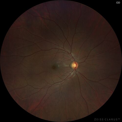 Normal Clarus Image
