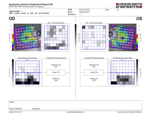 Normal Tension Glaucoma -  Posterior Pole Scan shows asymmetry consistent with Normal Tension Glaucoma
90 Year old man: IOP 9 OD, 11 OS
