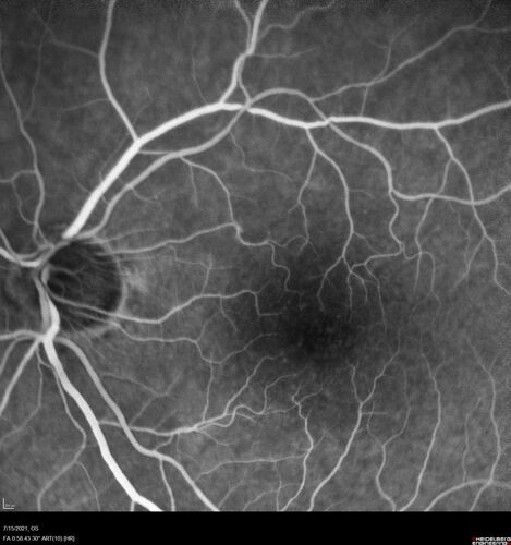 Normal Fluorescein Angiogram  01
