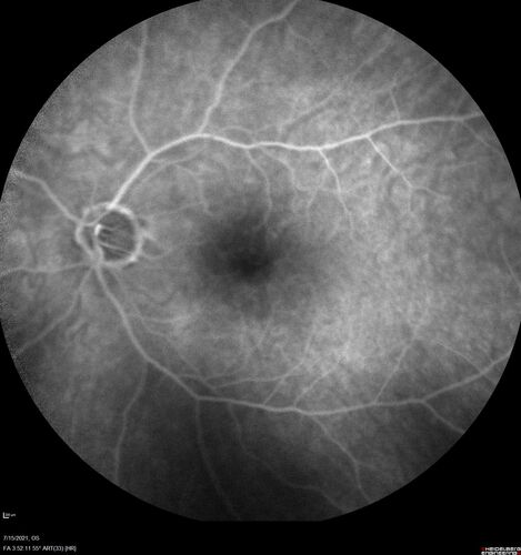 Normal Fluorescein Angiogram  03
