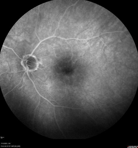 Normal Fluorescein Angiogram  04

