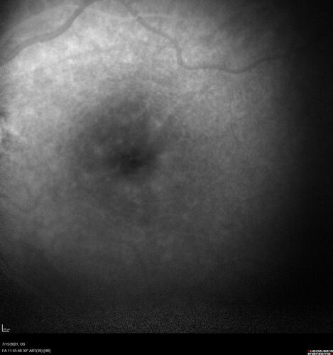 Normal Fluorescein Angiogram  05
