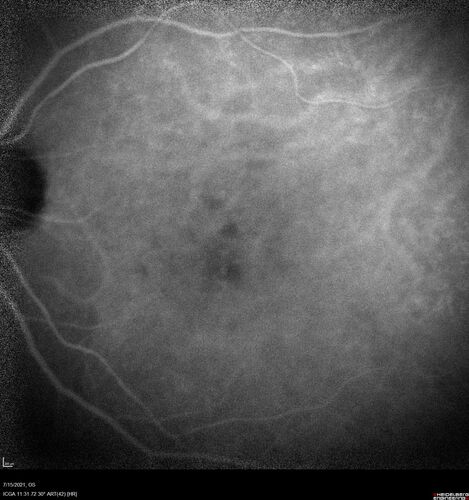Normal Indocyanine Green Angiogram  05
