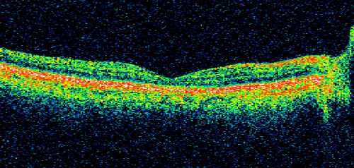 Occult Maculopathy - Thin Fovea on OCT and Normal Color VA, Photos, FA VA 20/80 OU
OCT Scan Right Eye shows foveal thinning. OD is 20/80, PH 20/70; OS is 20/80, PH 20/70.   His color vision is normal with 13 out of 14 correct in each eye.  There is no afferent pupillary defect.
FLUORESCEIN ANGIOGRAPHY:   The FA is entirely normal.

Keywords: occult maculopathy;foveal atrophy