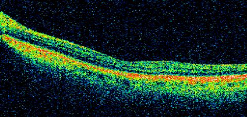 Occult Maculopathy - Thin Fovea on OCT and Normal Color VA, Photos, FA VA 20/80 OU
45-year-old man his mother and his maternal grandmother each had vision loss at a relatively young age.  Line scan shows foveal atrophy.
Keywords: occult maculopathy;foveal atrophy