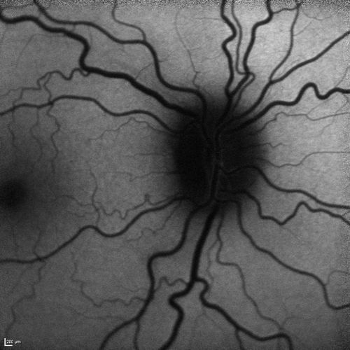 Optic Nerve (Disc) Drusen -  Fundus Autofluorescence
34 Year Old woman no headaches normal vision
