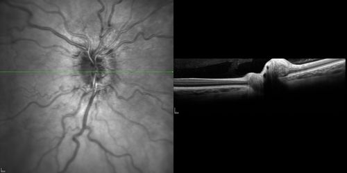 Optic Nerve (Disc) Drusen - Spectral Domain Optical Coherence Tomography Line Scan
34 Year Old woman no headaches normal vision
