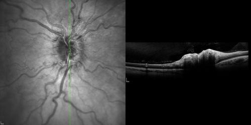 Optic Nerve (Disc) Drusen - Spectral Domain Optical Coherence Tomography Line Scan
34 Year Old woman no headaches normal vision
