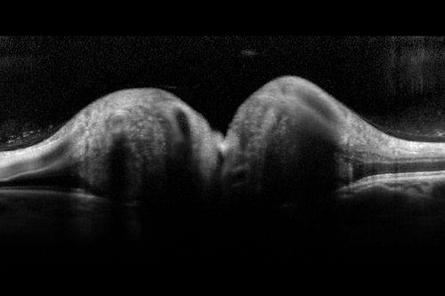 Optic Nerve (Disc) Drusen - Spectral Domain Optical Coherence Tomography Line Scan
34 Year Old woman no headaches normal vision
