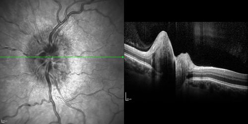 Optic Nerve (Disc) Drusen - Spectral Domain Optical Coherence Tomography Line Scan
34 Year Old woman no headaches normal vision
