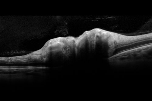 Optic Nerve (Disc) Drusen - Spectral Domain Optical Coherence Tomography Line Scan
34 Year Old woman no headaches normal vision
